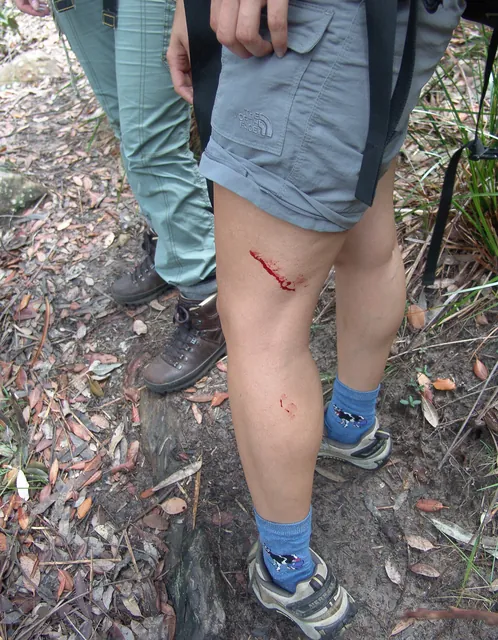 Naz fell victim to the blood suckers - the leech's saliva dilates the vessels and thins the blood