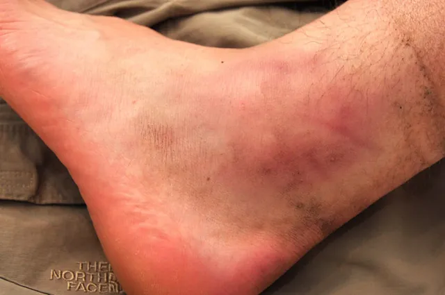 I bash my ankle in a dry river bed 1hr30mins in and this leads to 3 more sprains during the event