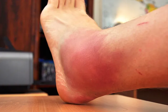 UPDATE: My swollen c'ankle the next morning... one word, ouchy!